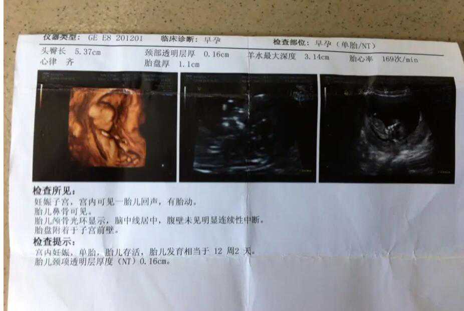 重庆有要助孕的吗 重庆妇幼试管三代费用多少? ‘17周双顶径38股骨23男孩女孩’